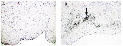 Calcification of Human Saphenous Vein Associated with Endothelial Dysfunction: A Pilot Histopathophysiological and Demographical Study